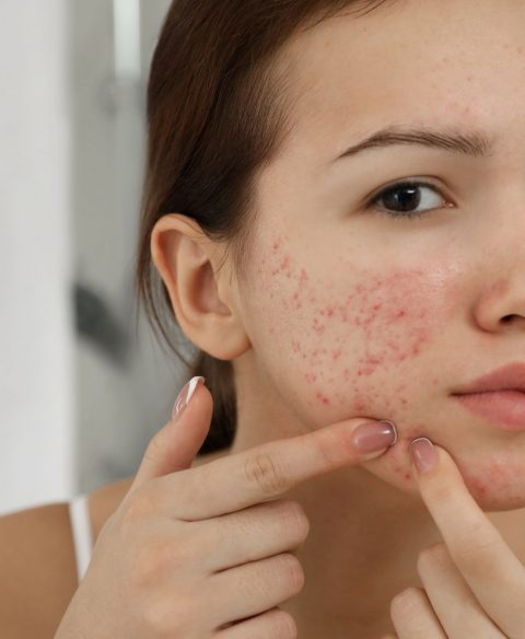 Acne & Blemishes - Learn More About them
